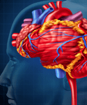High-Power, Short-Duration Ablation Linked With Higher Stroke Risk