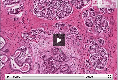 Cystic Fibrosis Pathology