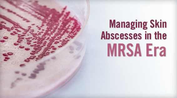 Managing Skin Abscesses in the MRSA Era