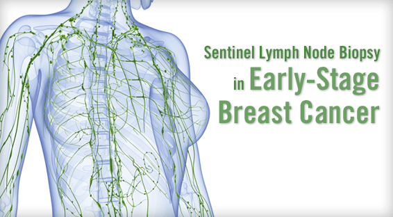 Sentinel Lymph Node Biopsy in Early-Stage Breast Cancer