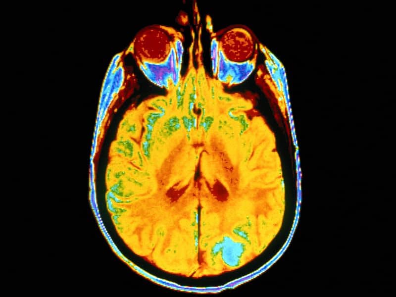 Nivolumab + Ipilimumab Shows Efficacy for Untreated Brain Mets