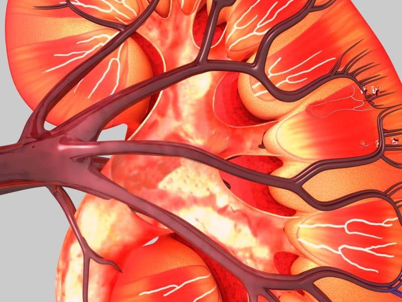 Enlarged Kidneys in Neonates With Congenital Heart Disease