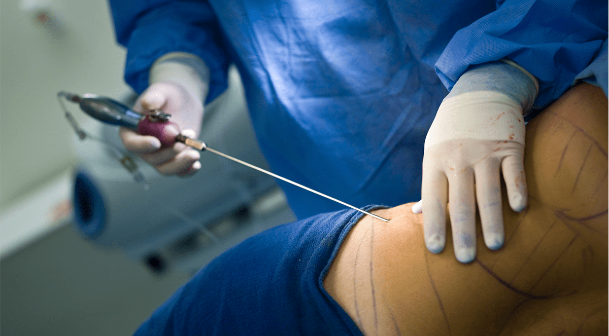 Lipo Blunders, Yet a 4-Star Doc Rating