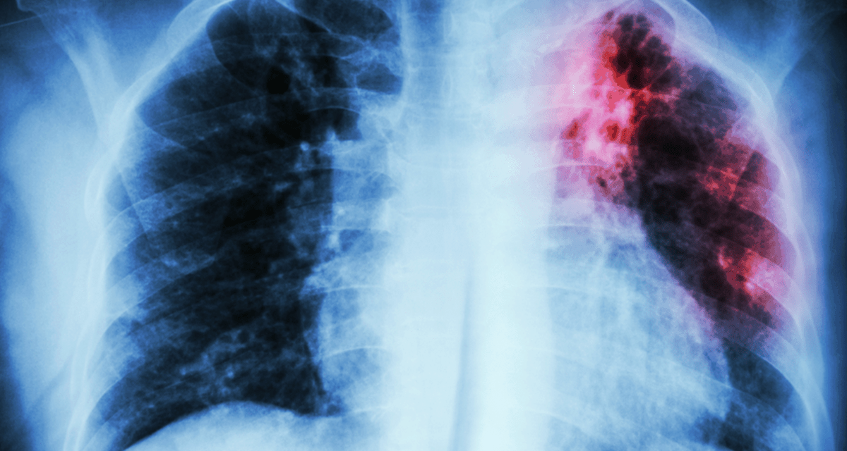Three New Lung Cancer Genetic Biomarkers Identified