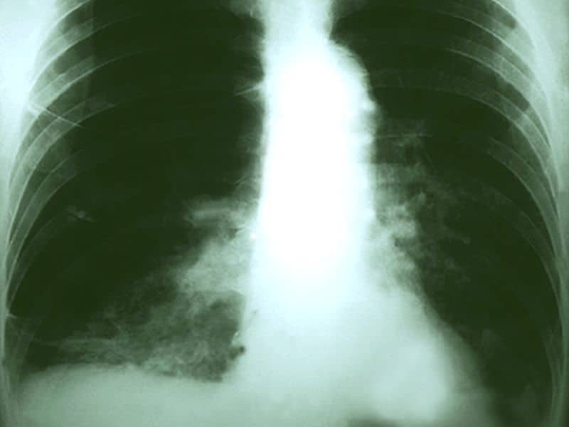 More Frequent Surveillance No Benefit After NSCLC Resection