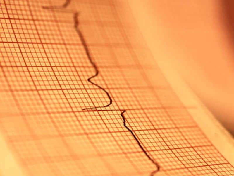 Greater Patient Delays for Women With STEMI Than Men