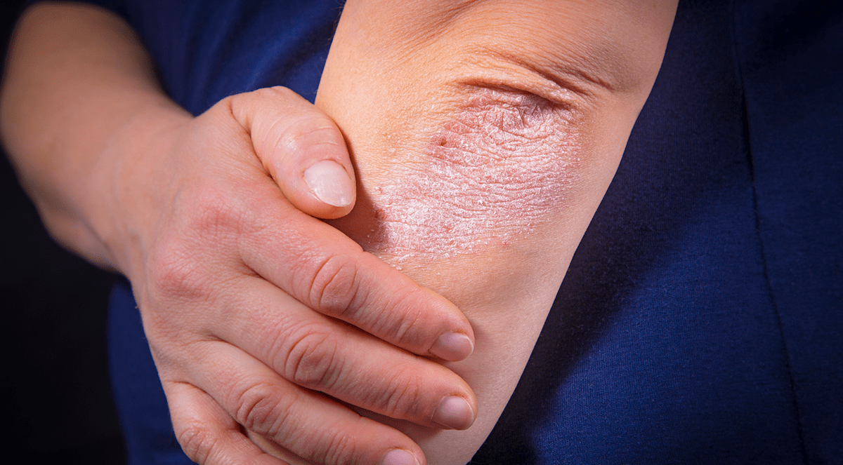 Antibiotics Not Effective for Clinically Infected Eczema in Children
