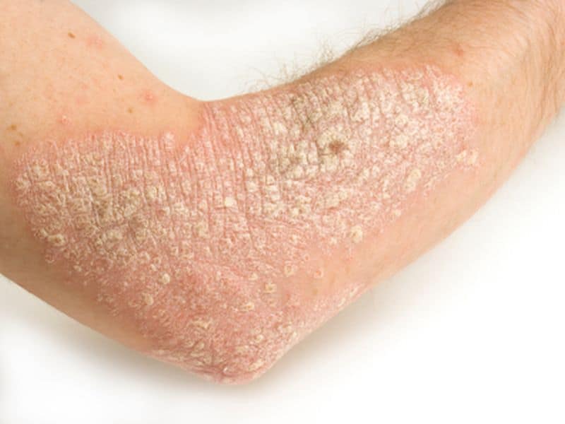 Alternative Medicines May Aid in the Treatment of Psoriasis