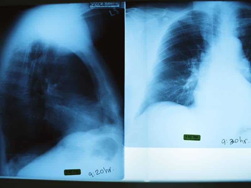 Artificial Intelligence System Can Triage Chest Radiographs
