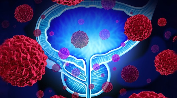 Researchers Reveal Biomarker for Guiding Prostate Cancer Treatment