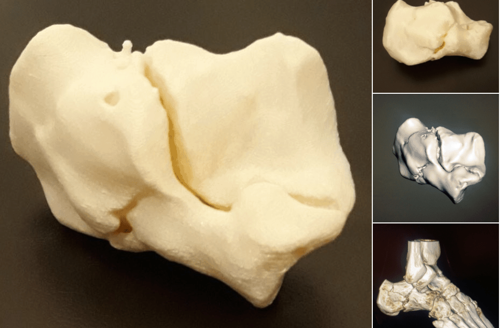 3D Printing Shows Talocalcaneal Joint Very Well!