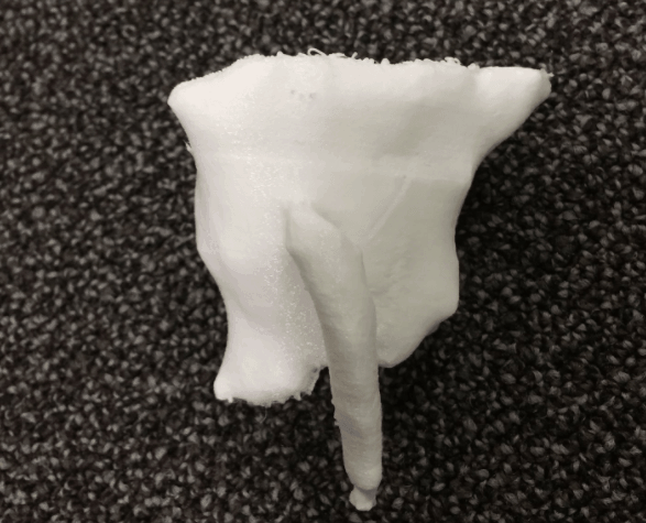 3D Printing Aids Fistulotomy