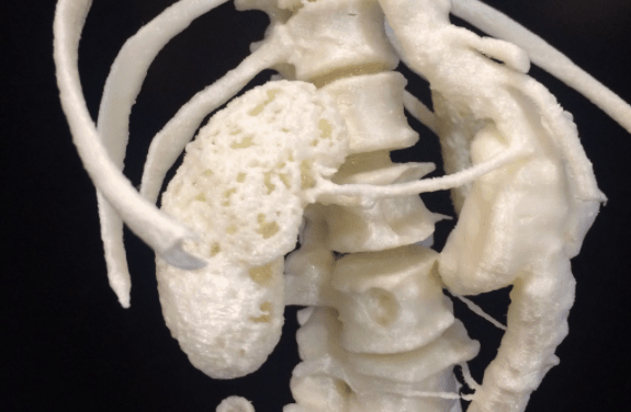 3D Printing a Q Fever-Infected Aortic Aneurysm