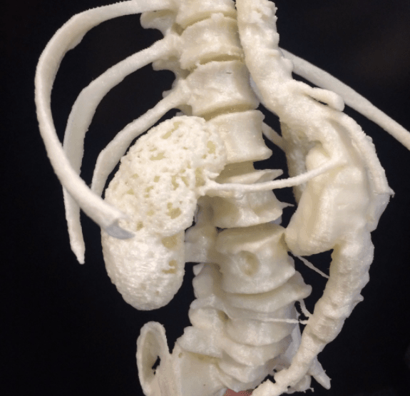 3D Printing a Q Fever-Infected Aortic Aneurysm