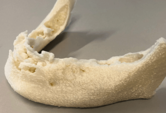 3D Printing an Osteoporotic Mandible to Aid in Surgery
