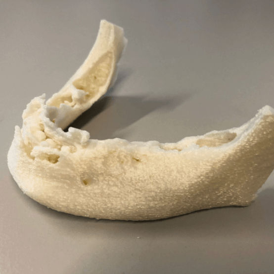 3D Printing an Osteoporotic Mandible to Aid in Surgery