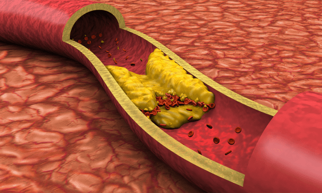 Atherosclerosis Events in SLE
