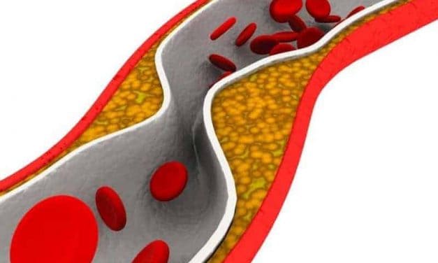 Pictorial Presentation of Silent Atherosclerosis Helps Cut CV Risk