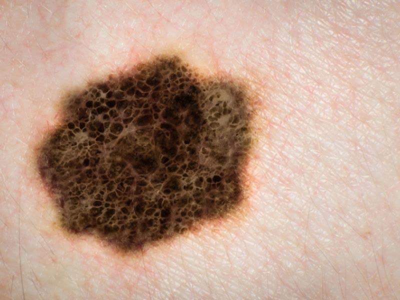 Stage IV Melanoma of Unknown Primary