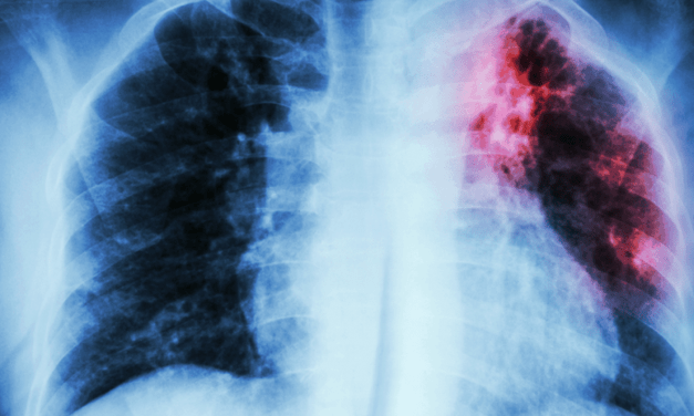 Global Burden of Tuberculosis: Are We Making Any Improvements?