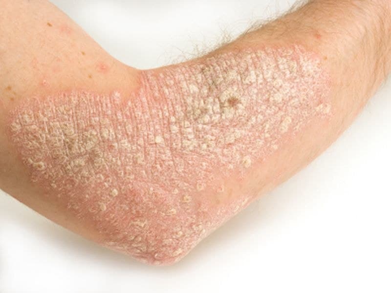 Certolizumab Looks Promising for Moderate-to-Severe Psoriasis