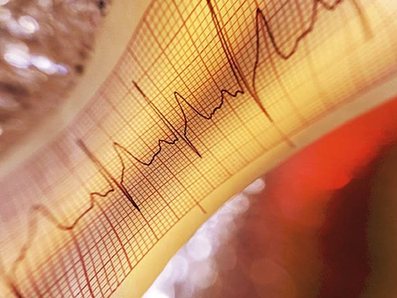 USPSTF: No to ECG Screening to Prevent CVD in Low-Risk Adults