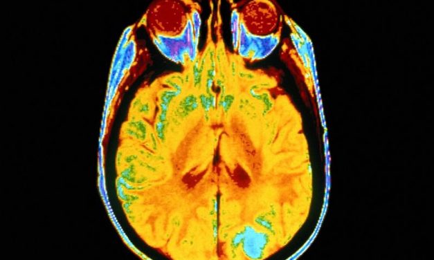Amyloid PET Tied to Diagnostic Changes in Memory Clinic Cohort