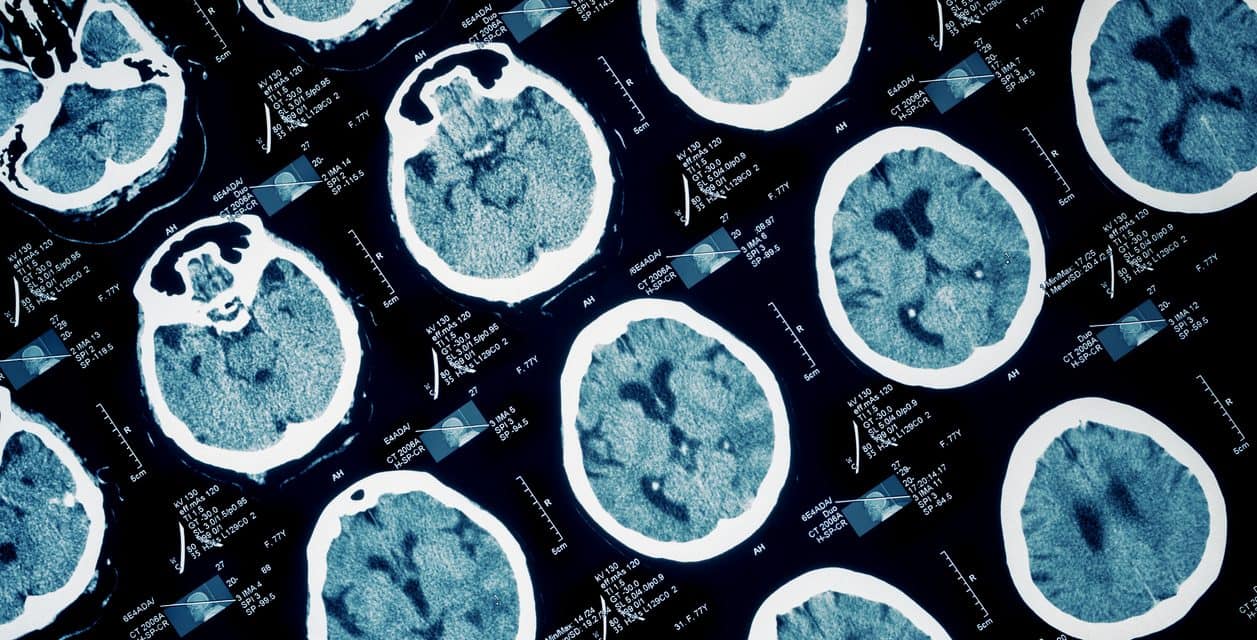 LIMIT-NI Reduces Neuroimaging in Recurrent Seizure Patients Vs. Unstructured Clinician Judgment