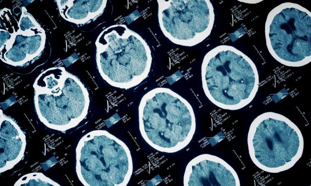 White Matter Iron Rim Lesions Predict Worse Disability in Multiple Sclerosis