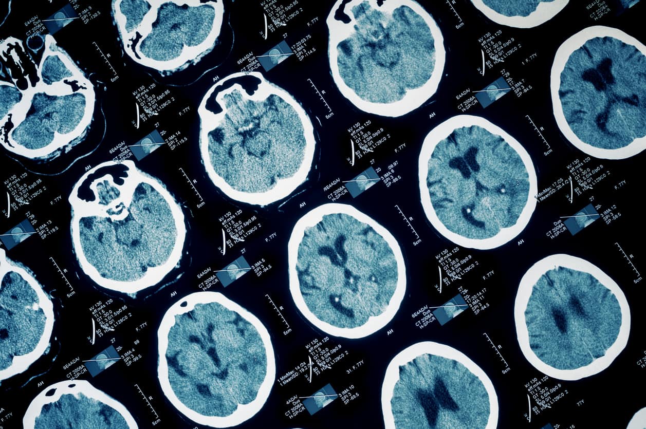 White Matter Iron Rim Lesions Predict Worse Disability in Multiple Sclerosis
