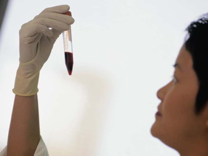 Single Blood Sample Test May Help ID Undiagnosed Diabetes