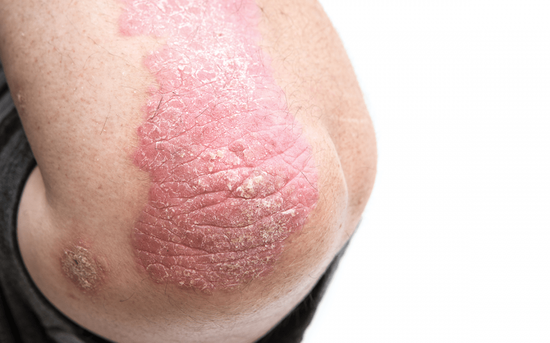 Simplified Assessment Tool Predicts Psoriasis Severity