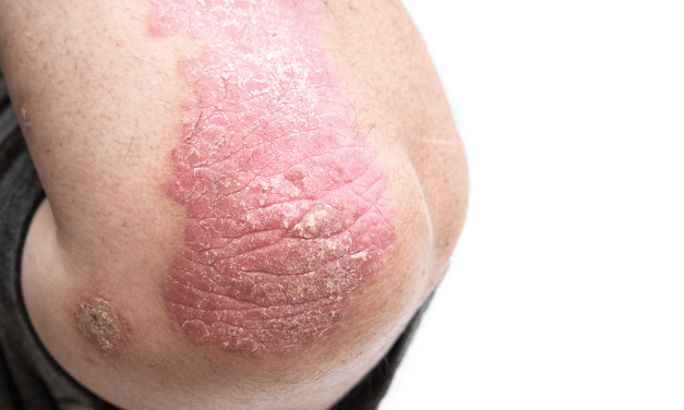 Incident Psoriasis: Associations of Combined Lifestyle & Genetic Risks