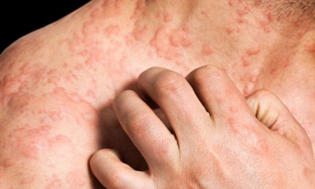 Anxiety, Depression More Likely for Adults With Atopic Dermatitis