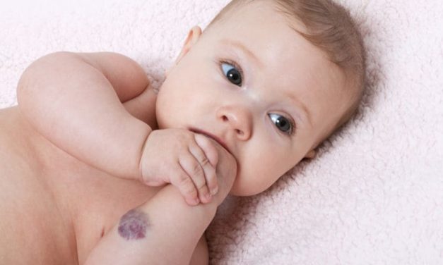 New AAP Guideline Available for Infantile Hemangioma Treatment