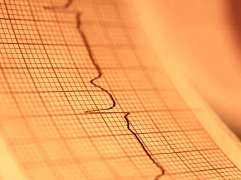 County-Level Poverty Strongly Tied to Heart Failure Mortality