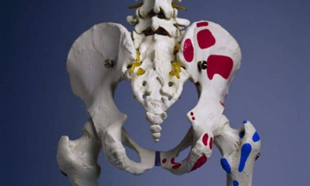 Hip Fracture Linked to Increased Risk for Death in T2DM Patients