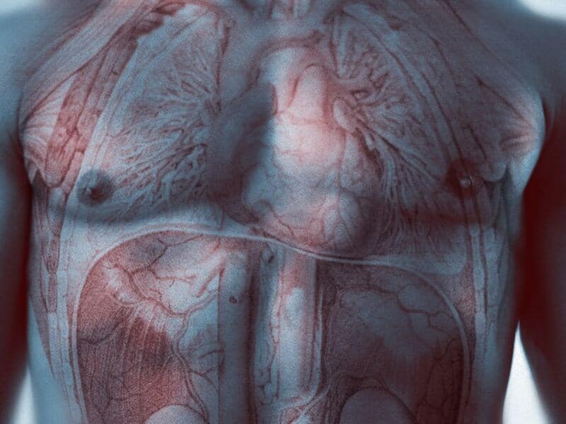 Lifetime Risks for Peripheral Artery Disease Higher for Blacks