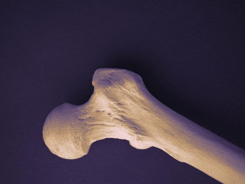 Statins Tied to Osteoporosis in Dose-Dependent Manner