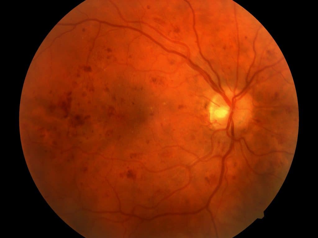 a retina with severe non-proliferative diabetic retinopathy