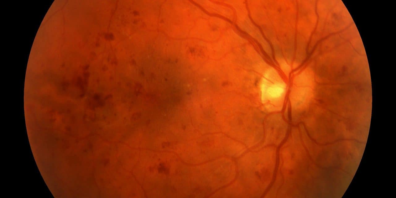 Early Retinal Development: Cell Destiny Choices, Signalling, and Transcription Factors
