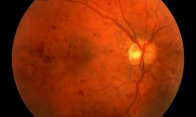 Retinal Vein Occlusion Associated With COVID Infection