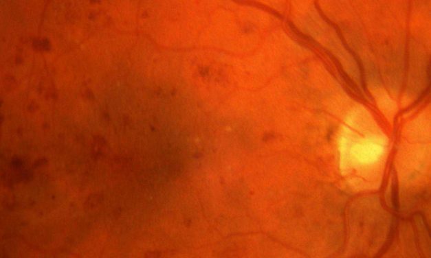 Age-related Macular Degeneration in Photoreceptor Layer Thinning