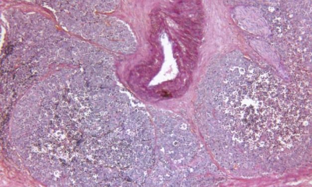Combination Biopsy Strategy May Identify More Prostate Cancers