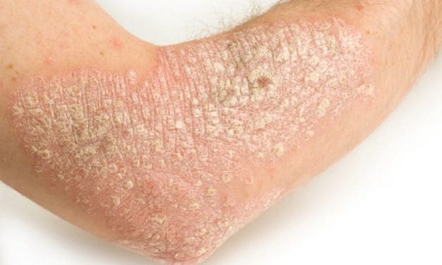 Psoriasis Tied to High BMI, Low Meat Intake in Japanese Study