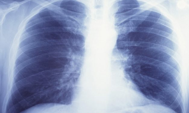 USPSTF Lung Cancer Screening Too Conservative for Blacks
