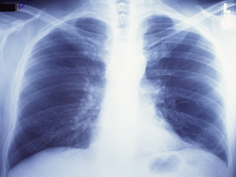 USPSTF Lung Cancer Screening Too Conservative for Blacks