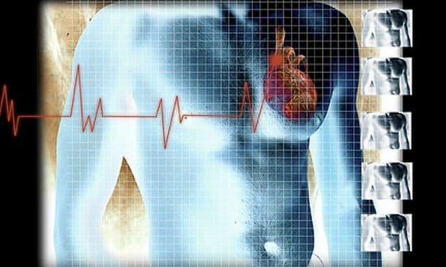 HIV Infection May Raise Risk for Atrial Fibrillation