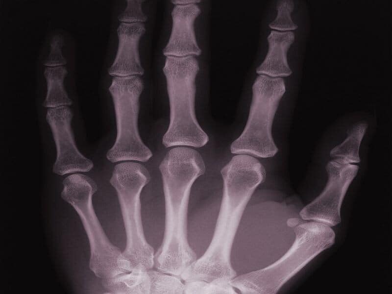 Serum IL-35 Levels Tied to Bone Loss With Rheumatoid Arthritis