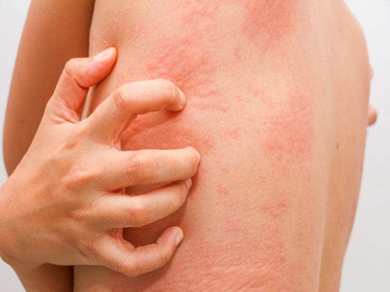 Ligelizumab Safely, Effectively Treats Hives